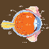 Uveitis